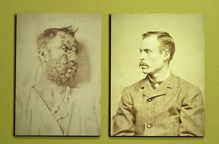 syphilis before and after treatment